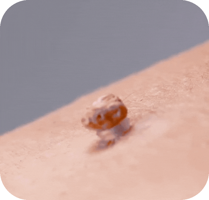 TagClear™ – Smertfri fjernelse af hudflapper