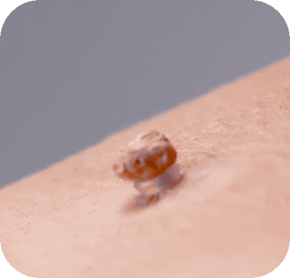 TagClear™ – Smertfri fjernelse af hudflapper